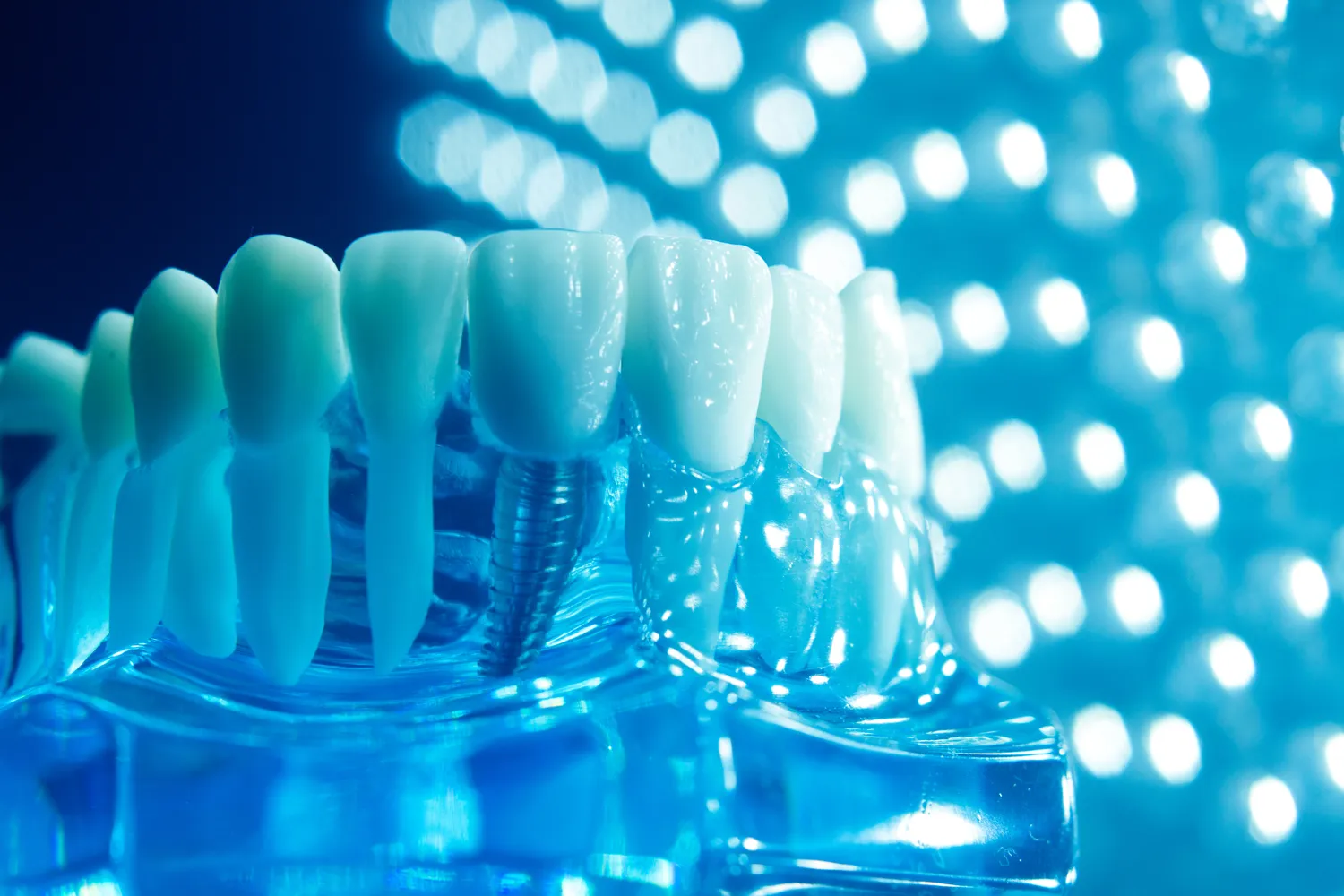 Implanty stomatologiczne